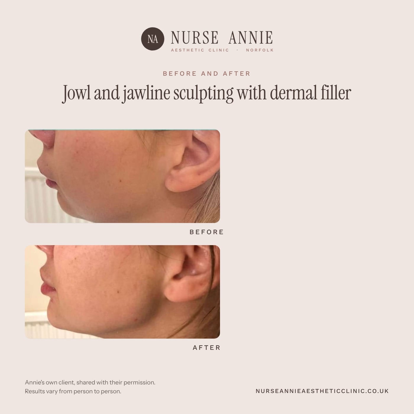 Before and after jowl and jawline filler at Nurse Annie Aesthetic Clinic, Wymondham